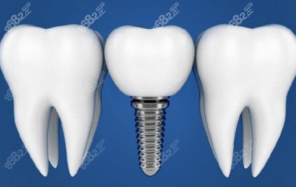满口种植牙怎么做便宜价格表