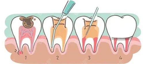 牙齿根管治疗动画图