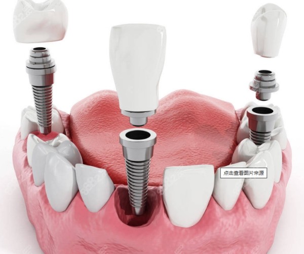 满口种植牙怎么做便宜全固定