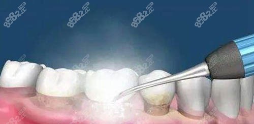 洗牙过程图
