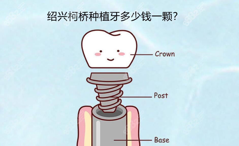 绍兴柯桥种植牙多少钱一颗