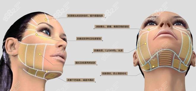 超声王除皱同时可以改善面部轮廓