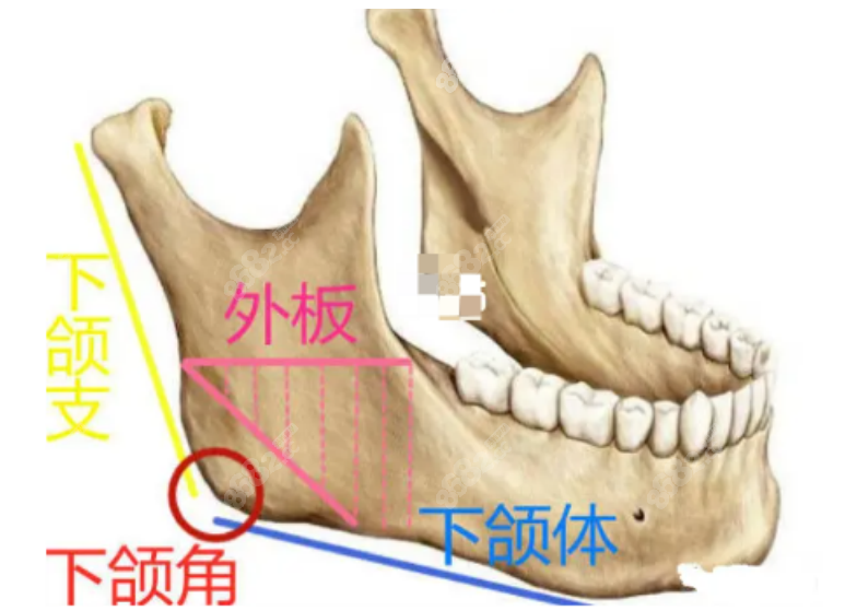 下颌角修复