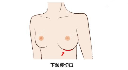 下皱襞隆胸切口隐蔽疤痕不明显