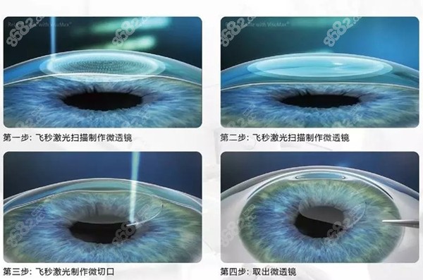 郑州尖峰眼科做全飞秒手术较为好
