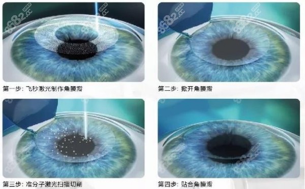 <!--<i data=20240705-sp></i>-->眼科做半飞秒手术较好