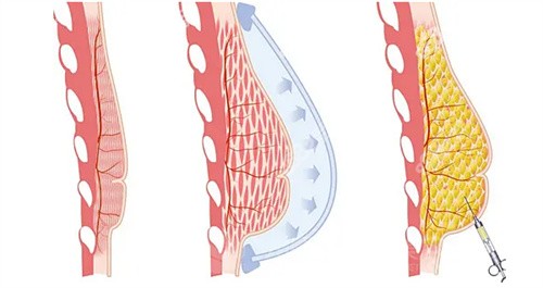 豐胸針一針多少錢？