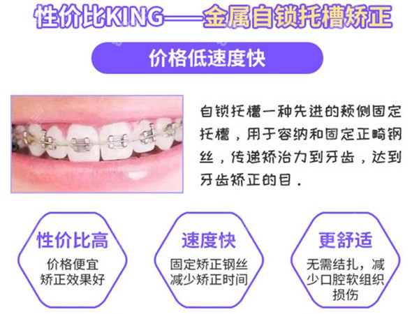 美国奥美科自锁牙套优势8682.cc