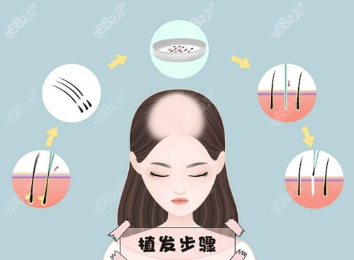 赤峰悦美医疗美容植发优势介绍