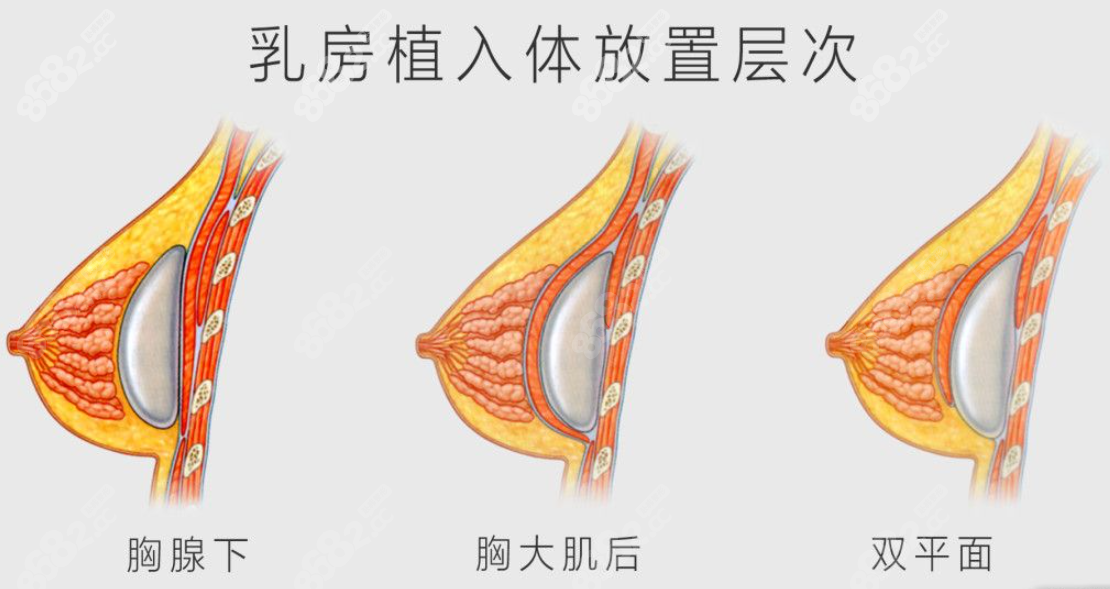 假体隆胸