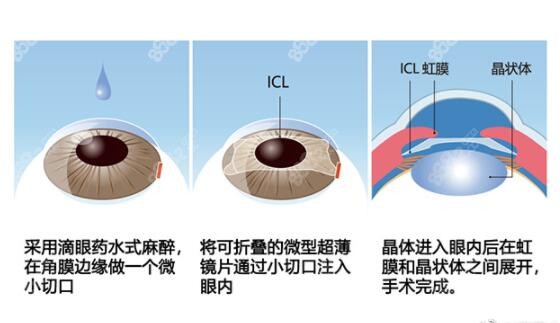 icl晶体植入近视手术过程示意图