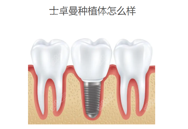 士卓曼种植体怎么样