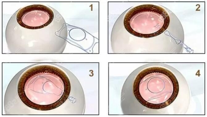 icl晶体植入手术的优缺点,一文带你了解icl晶体植入手术