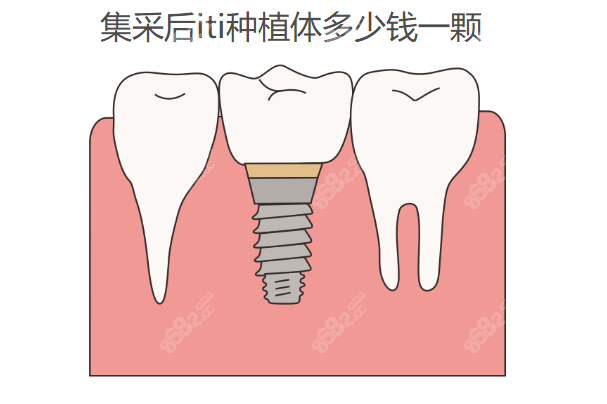 集采后iti种植体多少钱一颗