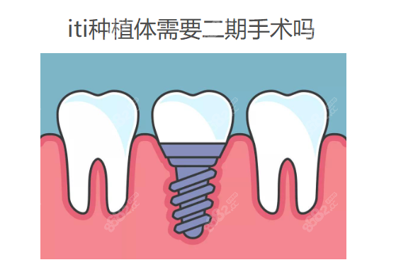 iti种植体需要二期手术吗