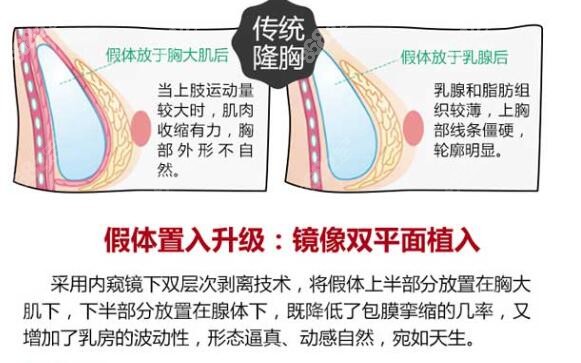 传统假体隆胸和双平面隆胸的区别