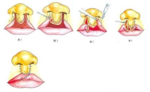 腭裂修复术术示意图图片