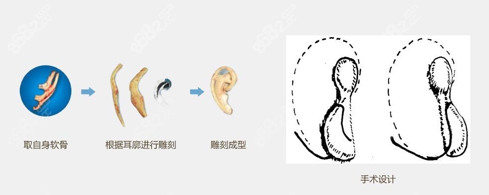 <!--<i data=20240705-sp></i>-->医生做耳再造手术过程