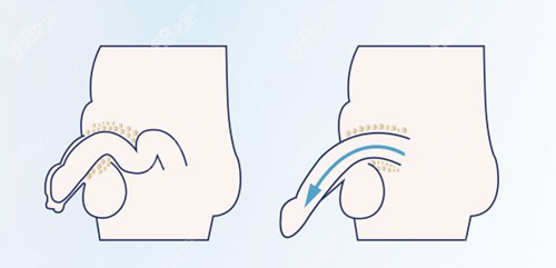 重庆星荣整形外科医院阴茎延长手术