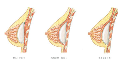 广州曙光吴毅平双平面隆胸