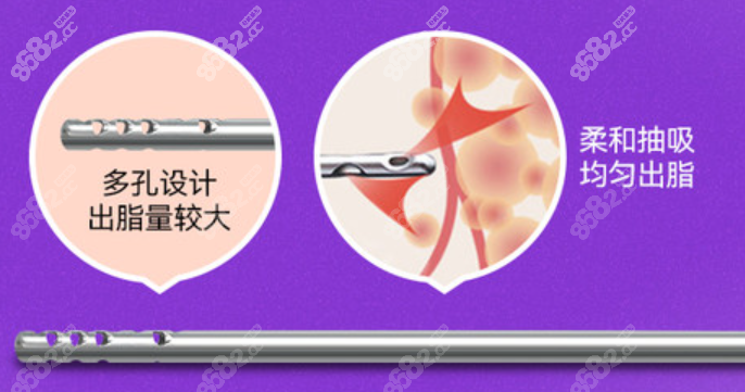 杭州维多利亚整形医院腰腹吸脂多少钱