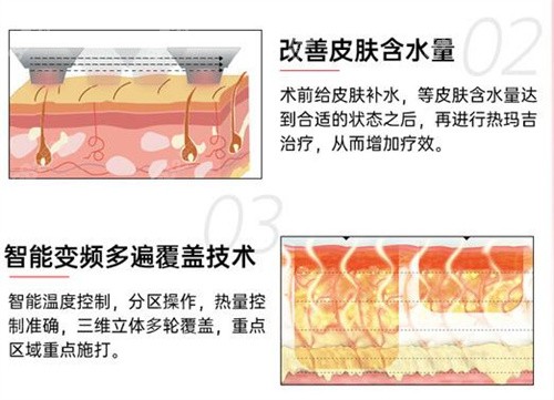 深圳艺星热玛吉补水