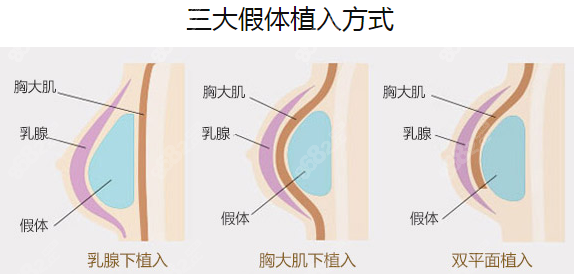 裴柄万隆胸怎么样