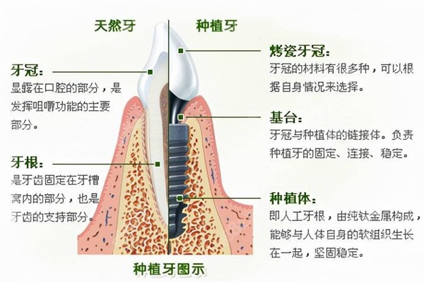 种植牙与天然牙的对比www.8682.cc
