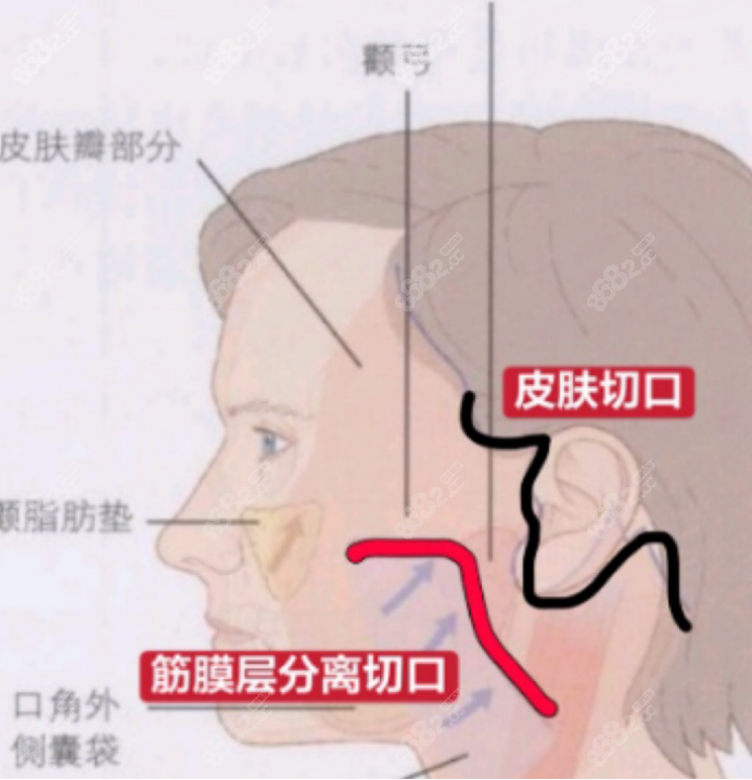 马静医生拉皮