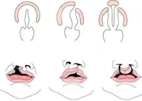 南京兔唇修復哪家醫(yī)院好