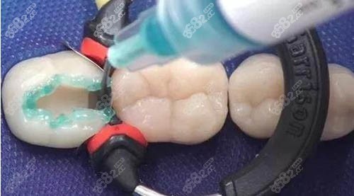 补牙过程图