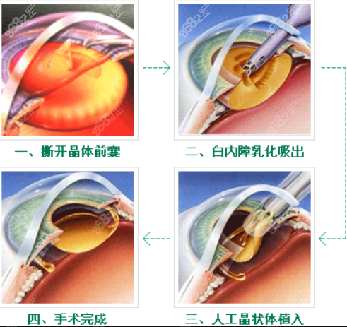 刘保松做白内障晶体植入手术好