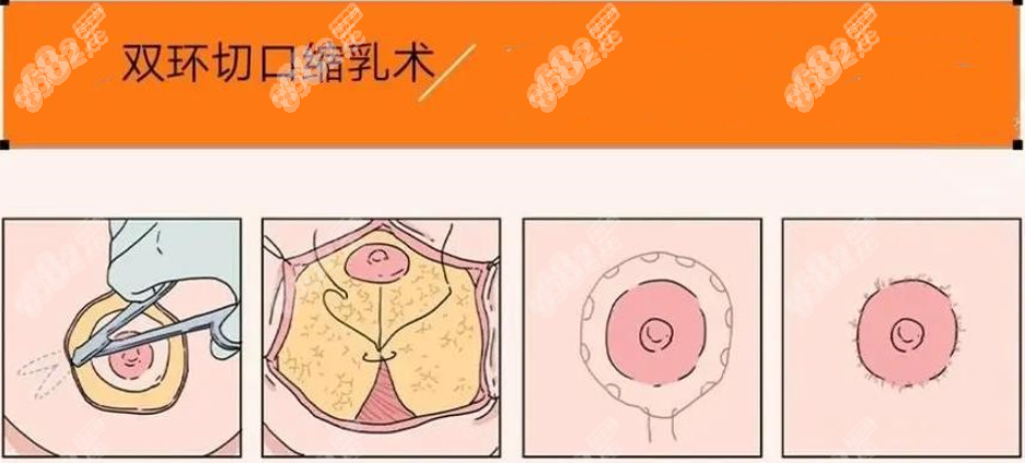 双环切口