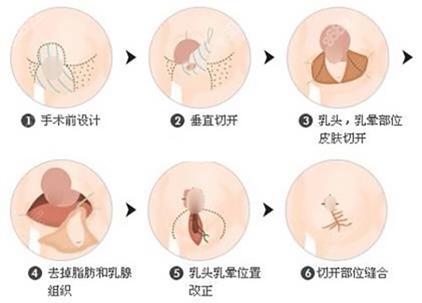 北京杨大平做胸做得怎么样？