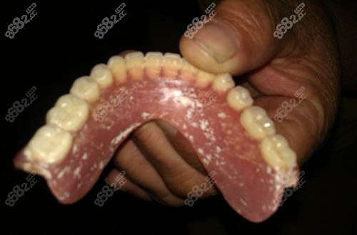 半口义齿照片