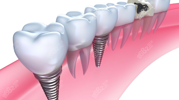 种植牙示意图