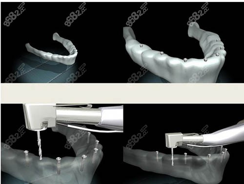 种植牙动画模拟图