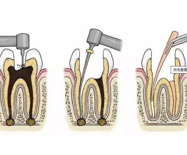 为什么二次根管更容易失败原因