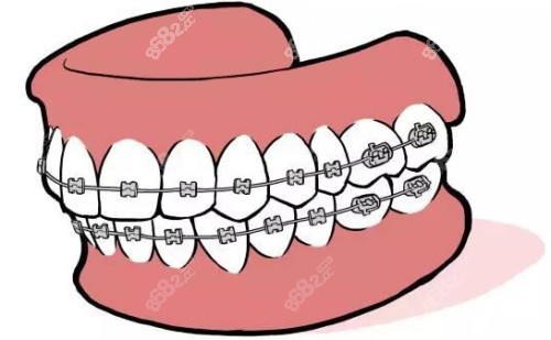 金属固定牙套示意图