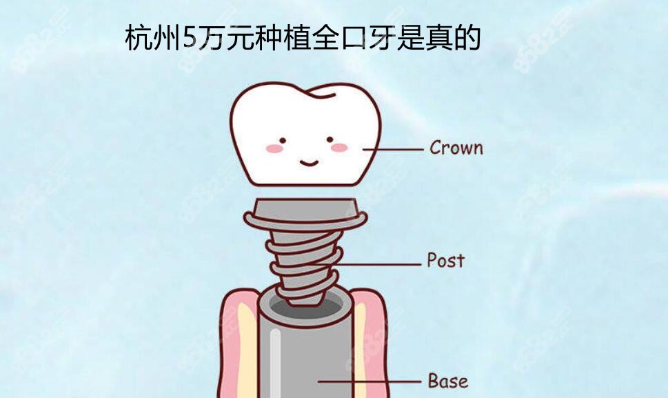 杭州5万元种植全口牙是真的