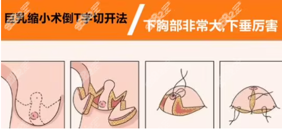 缩胸手术切口图示8682.cc