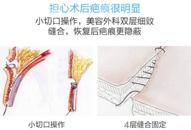 朱迪医生处理眼部疤痕好