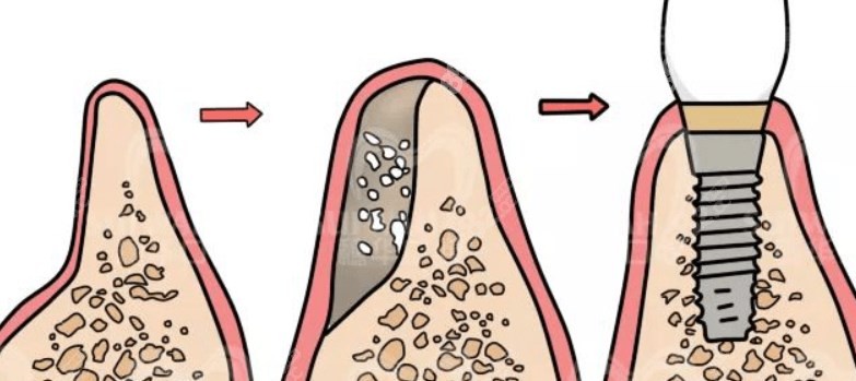 自体骨种植更牢固