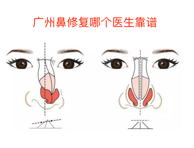 广州鼻修复哪个医生靠谱?广州鼻修复医生排名前十名单