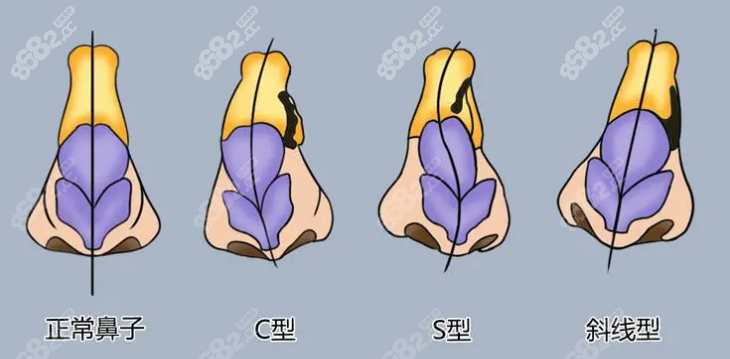 鼻子被打歪了算轻伤吗8682.cc