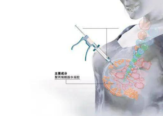 20年前做过注射隆胸