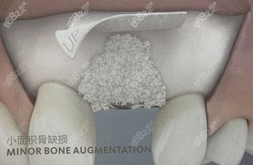 唇腭裂牙槽植骨手术全过程