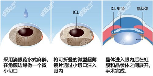 24小时免费医生在线咨询可解答：青光眼手术问题