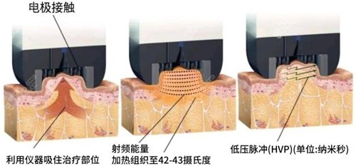 钻石超塑的原理