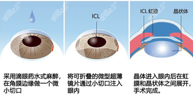 刘保松做icl晶体植入近视手术好